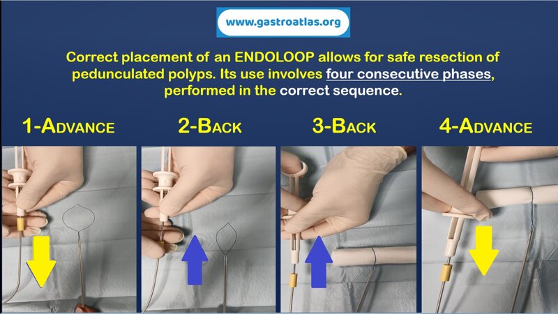endoloop-polypectomy-tips-and-tricks