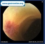 jejunal-angiodysplasia-vce