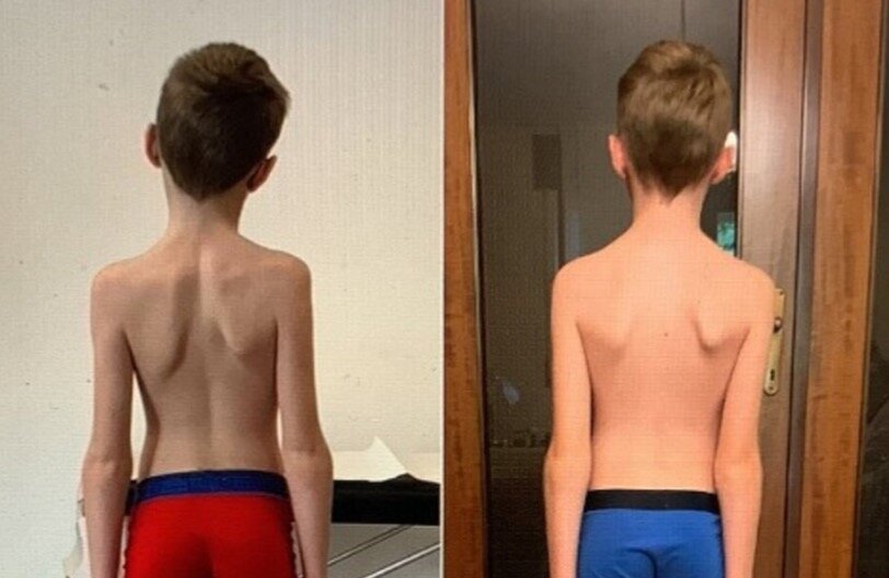 Difetto dell'occhio - la postura di Samuele