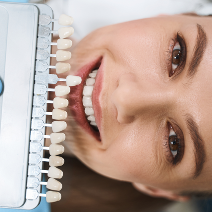 faccette dentali