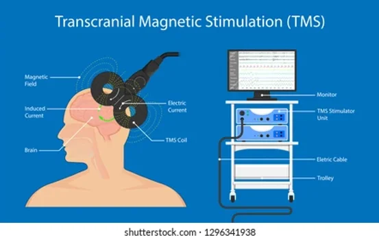 TMS al Centro Medico VIS Cerignola TMS al Centro Medico VIS Cerignola