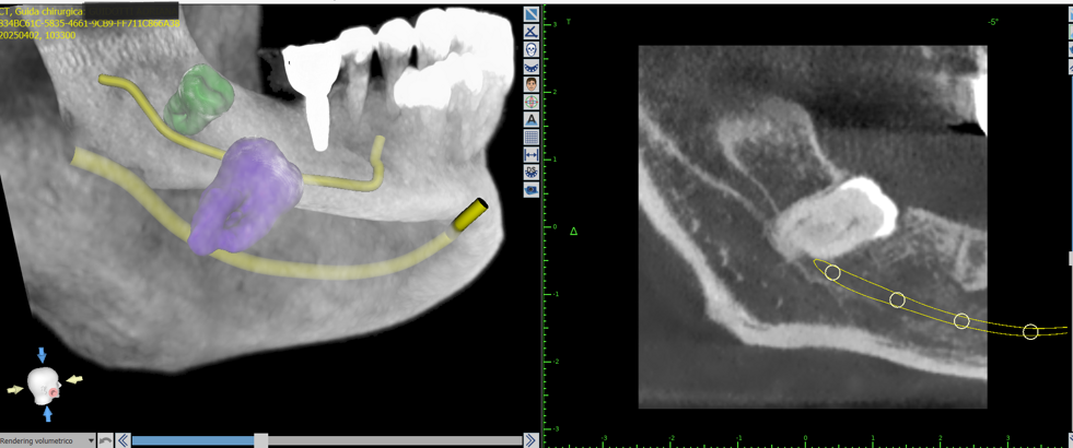 dente giudizio1 dente giudizio1
