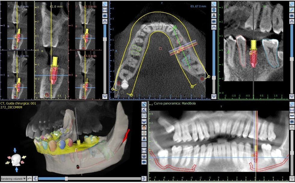 implantologia_guidata1.jpeg implantologia_guidata1.jpeg