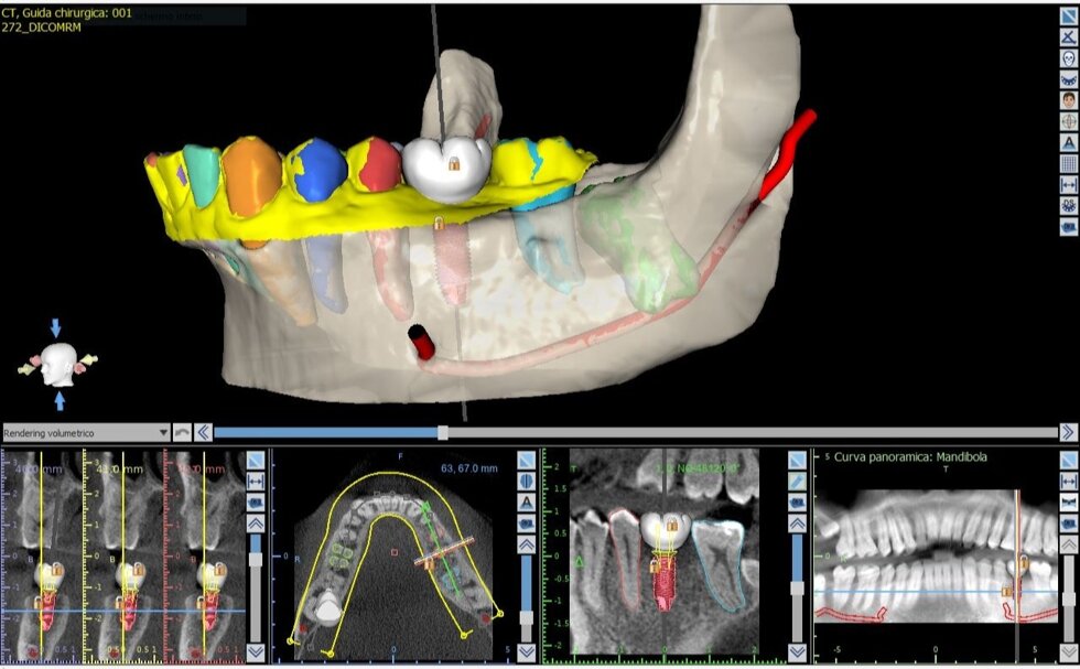 implantologia_guidata2.jpeg implantologia_guidata2.jpeg
