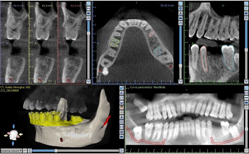implantologia_guidata.jpeg implantologia_guidata.jpeg
