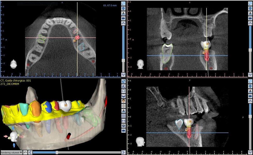 implantologia_guidata3.jpeg implantologia_guidata3.jpeg