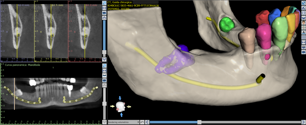 dente giudizio2 dente giudizio2