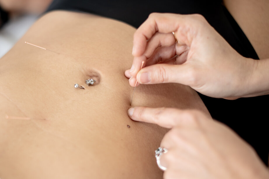 Agopuntura Agopuntura