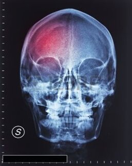 10213468-detail-of-head-xray-film-and-trauma