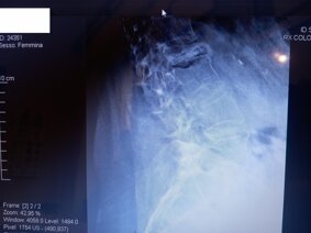 rx rachide toracico_cedimento vertebrale_a..jpeg