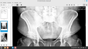 coxartrosi coxofemorale _ d.f.