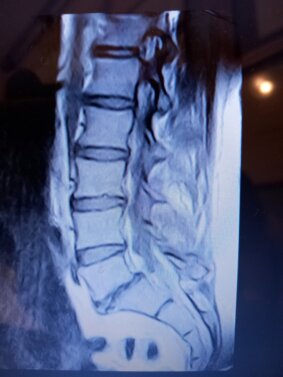 rmi rachide lombare d..jpeg