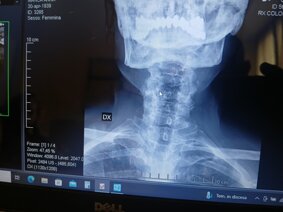 rx cervicale_ m.a. coronale.jpeg