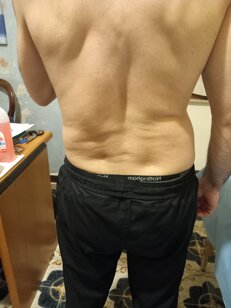 rotoscoliosi e disallineamento sacroiliaca_fisioterapia.jpeg