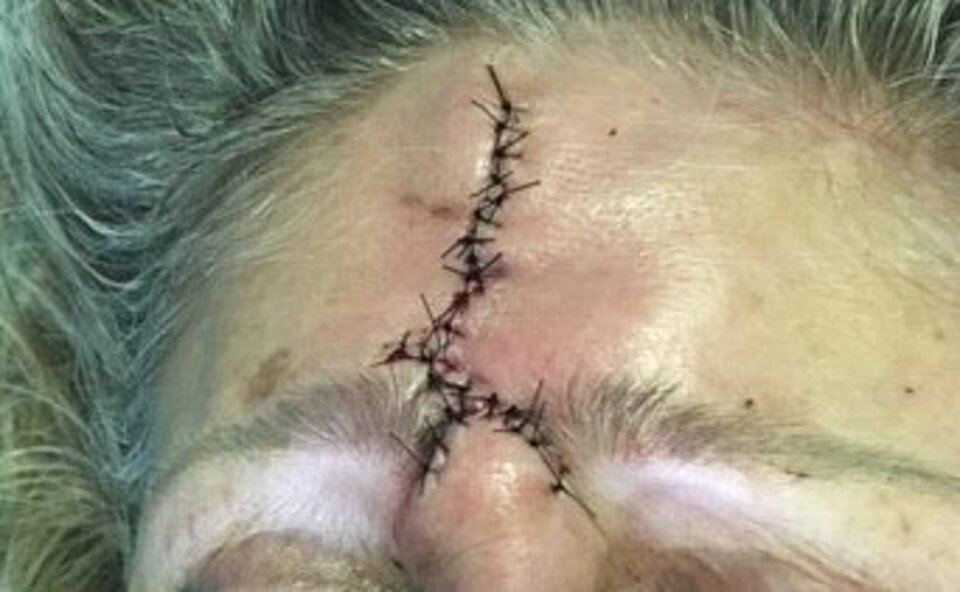 Ricostruzione plastica Ricostruzione plastica