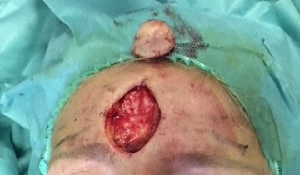 Exeresi a scodella Exeresi a scodella