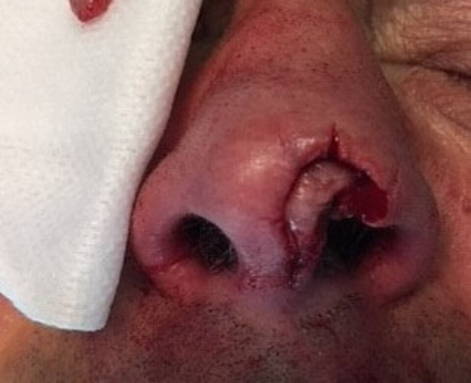 CARCINOMA BASOCELLULARE PUNTA NASO CARCINOMA BASOCELLULARE PUNTA NASO