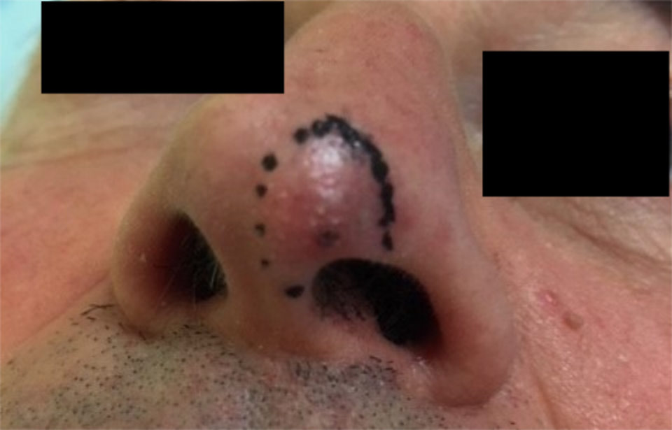 CARCINOMA BASOCELLULARE PUNTA NASO CARCINOMA BASOCELLULARE PUNTA NASO