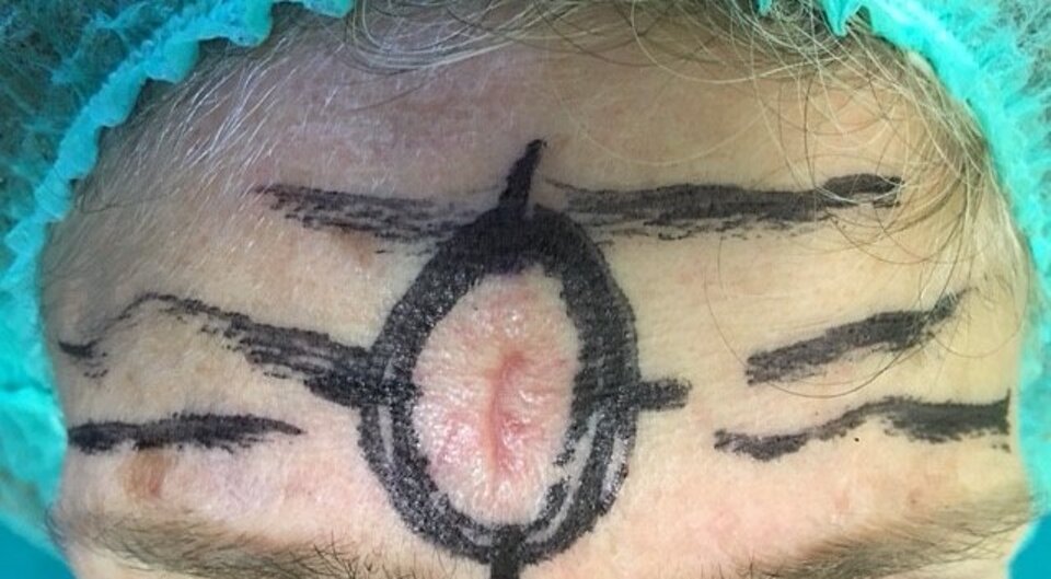 Mappatura lesione in vivo con matita dermografica Mappatura lesione in vivo con matita dermografica