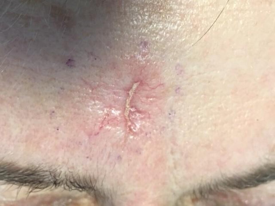 Carcinoma basocellulare della fronte Carcinoma basocellulare della fronte