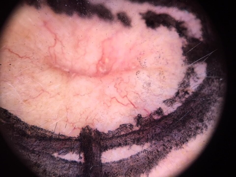 Valutazione dei margini in epiluminescenza Valutazione dei margini in epiluminescenza