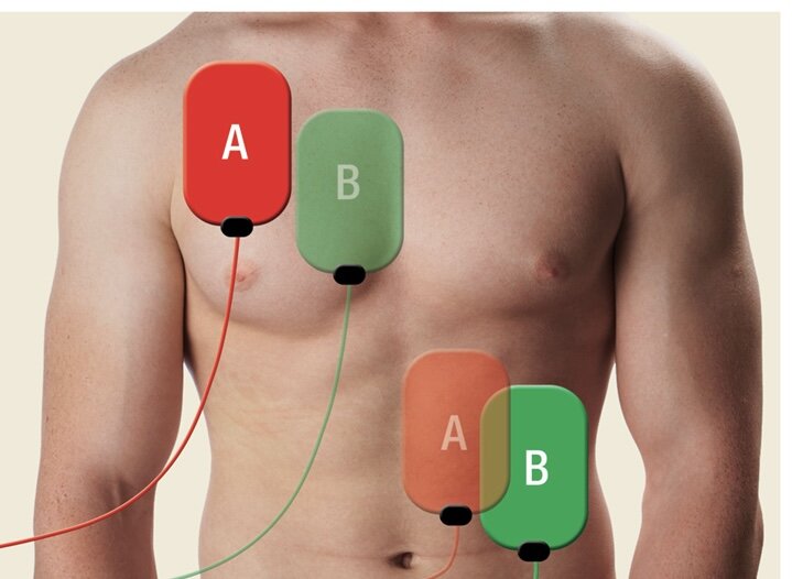 Strategjite e defibrilimit ne fibrilacionin ventrikular refraktar! Defibrilim i dyfishtë DSED dhe defibrilimi me ndryshim vektori VC! Strategjite e defibrilimit ne fibrilacionin ventrikular refraktar! Defibrilim i dyfishtë DSED dhe defibrilimi me ndryshim vektori VC!