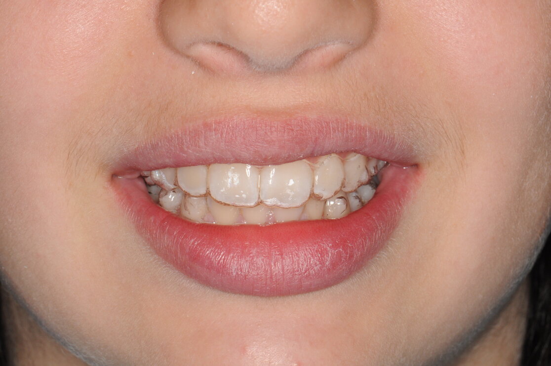 Trattamento ortodontico con allineatori in paziente adolescente