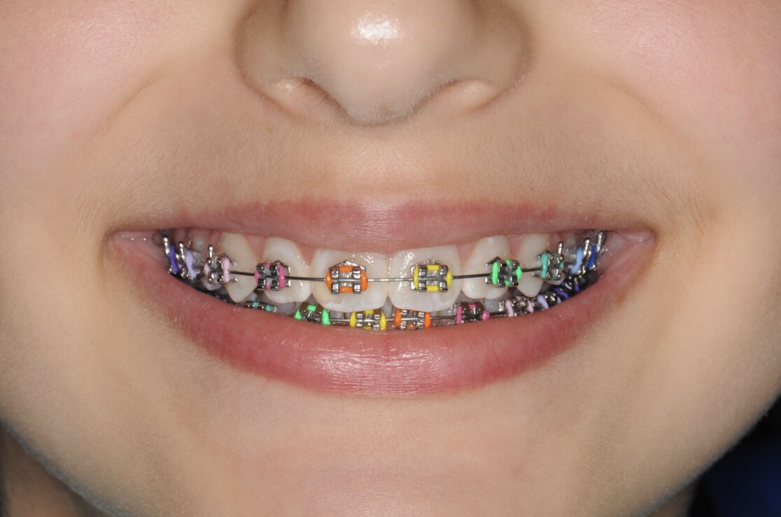 Apparecchio fisso multibrackets