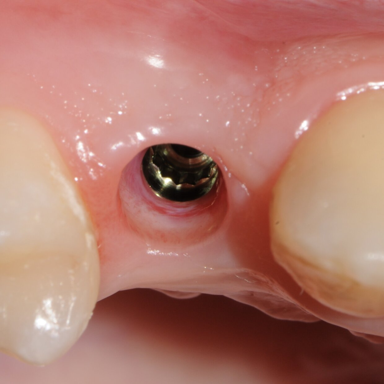 Dettaglio guarigione tessuto gengivale a 3 mesi