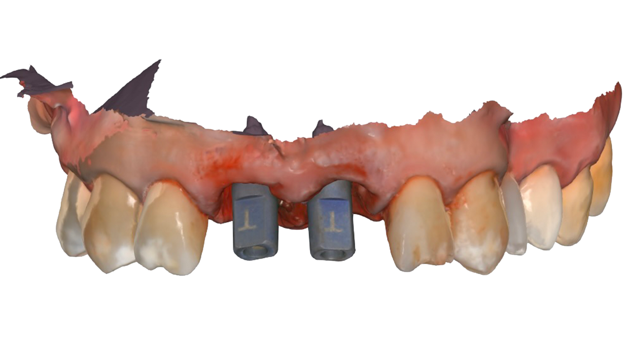 Impronta digitale post intervento