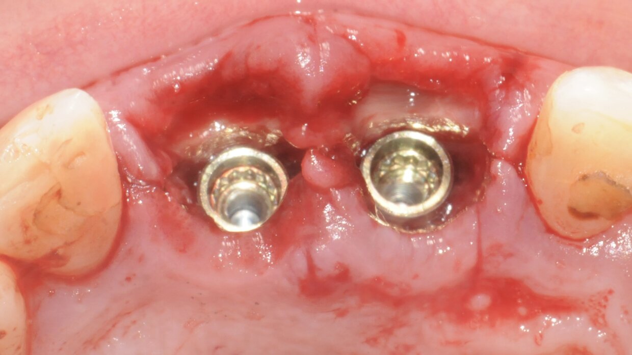 Inserimento impianti con tecnica Socket Shield