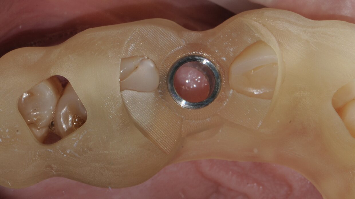 Dima chirurgica progettata prima dell'intervento per l'inserimento dell'impianto