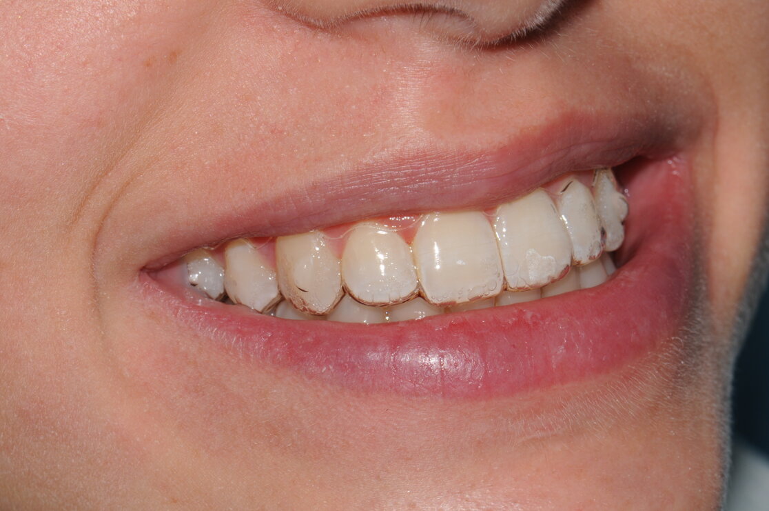 Allineatori trasparenti