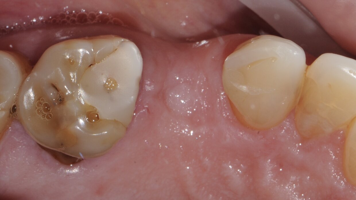 Caso iniziale: assenza del secondo premolare