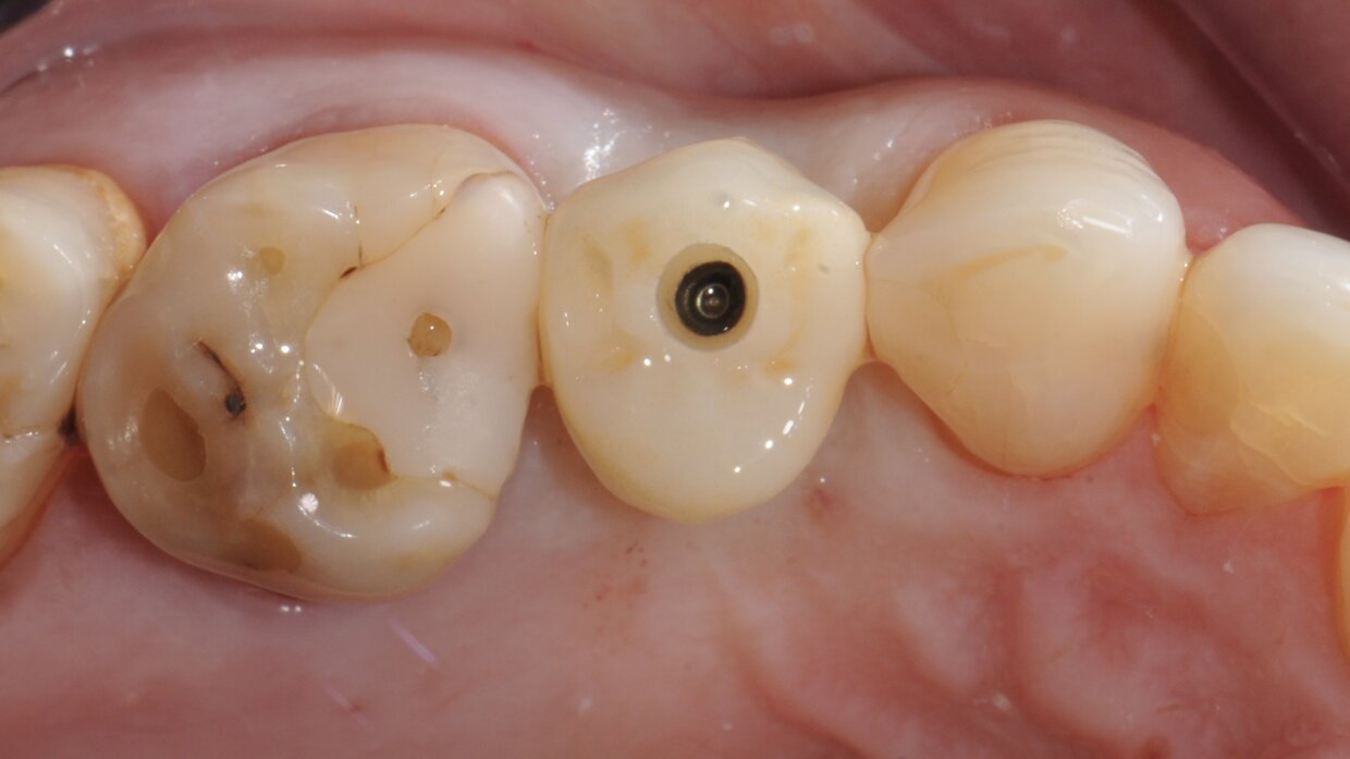 Corona avvitata in zirconio