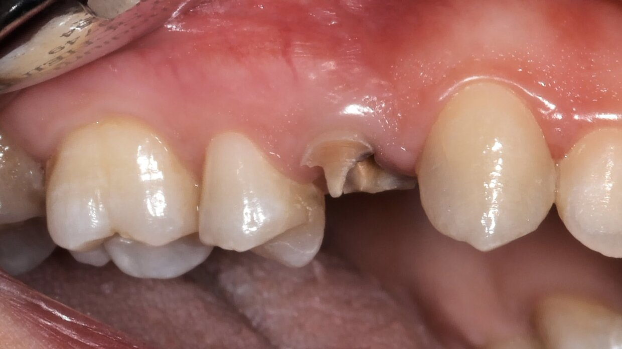 Caso iniziale: Frattura a carico del premolare