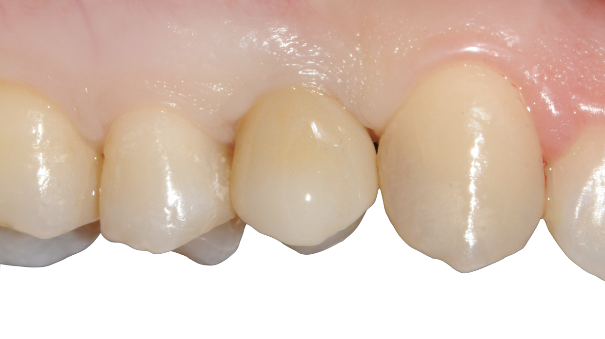 Cementazione elemento protesico definitivo