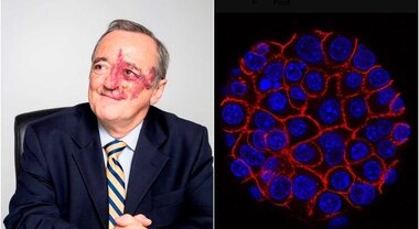 Tumore al pancreas, dalla Spagna una nuova cura con tre farmaci fa sperare: lo studio