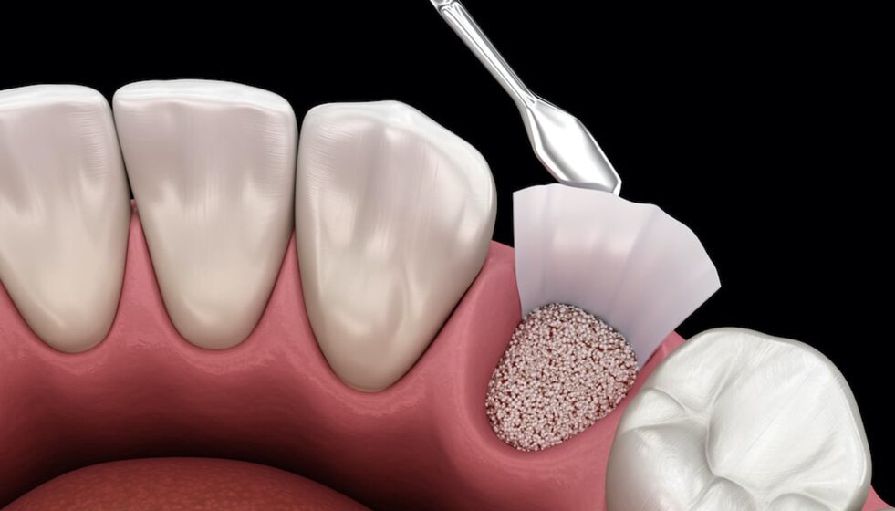 rigenerazione-ossea (1).jpeg