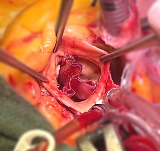 JTdCJTIyaXQlMjIlM0ElMjJDcmVhemlvbmUlMjBkZWklMjB0cmUlMjBsZW1iaSUyMGRlbGxhJTIwbmVvLXZhbHZvbGElMjBhb3J0aWNhJTIwc2Vjb25kbyUyMGxhJTIwdGVjbmljYSUyME96YWtpJTIwLSUyMERyLiUyMEZhYnJpemlvJTIwQ29ydGklMjAlRTIlODAlOTMlMjBDYXJkaW9jaGlydXJnbyUyME1vbnphJTIyJTdE