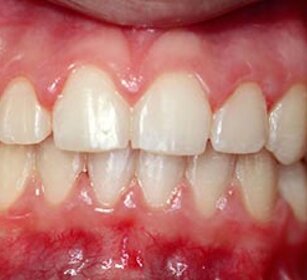 cura parodontite cura parodontite