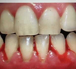 parodontite effetti della parodontite