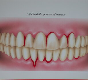 gengive infiammate gengive infiammate