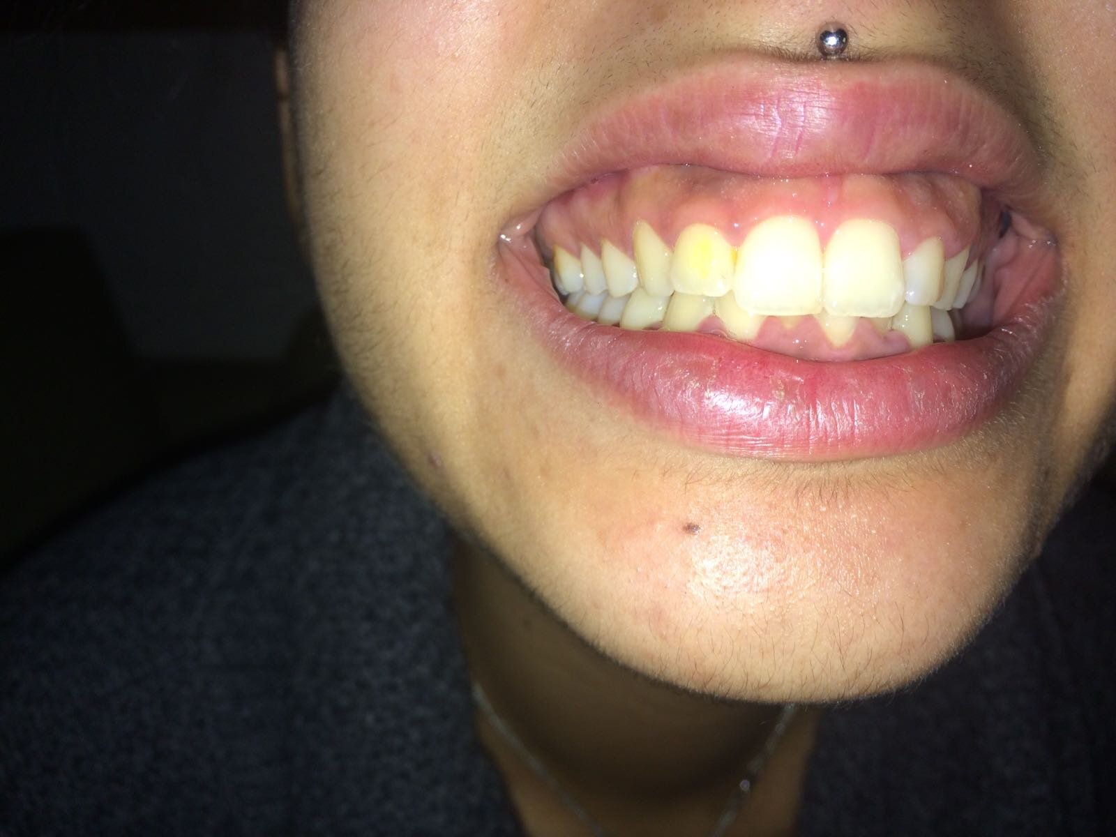 COLORE DEI DENTI COLORE DEI DENTI