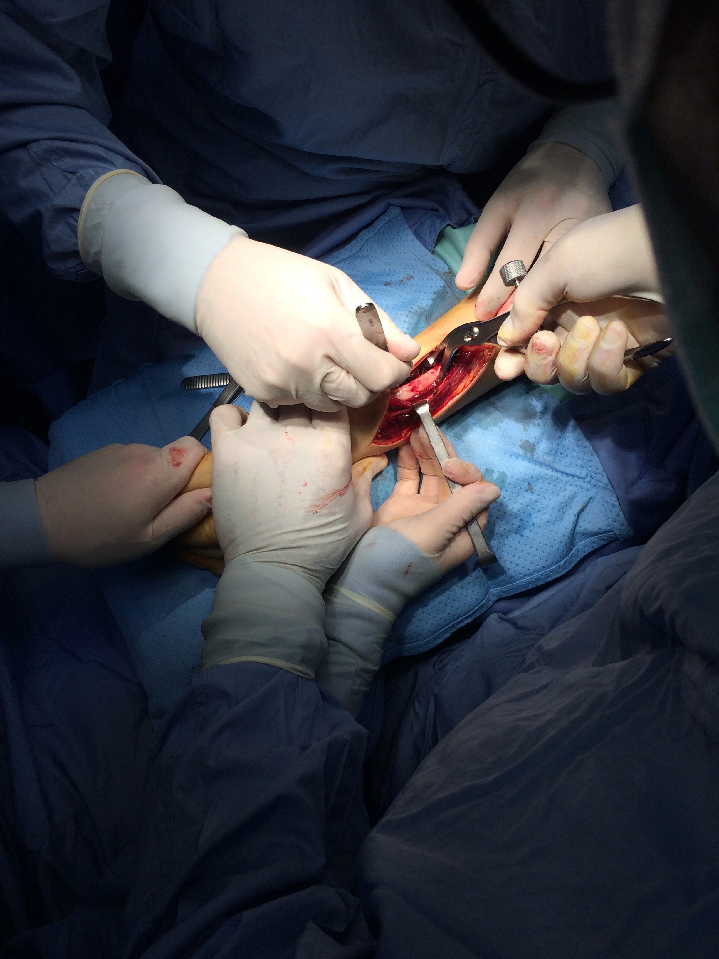 Casi di tubercolosi come conseguenza di infezioni della ferita chirurgica