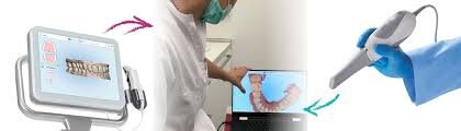 IMPRONTA DENTALE DIGITALE: COME FUNZIONA