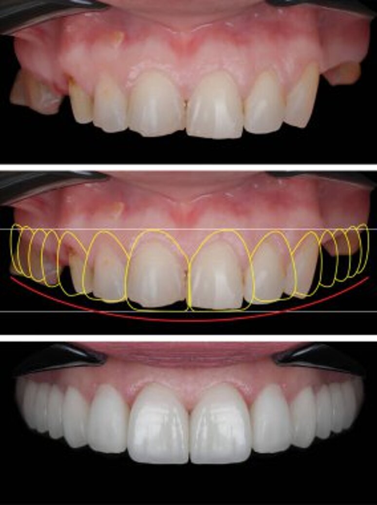 depositphotos_781510192-stock-photo-zygomatic-implant-treatment-dental-jaw.jpeg depositphotos_781510192-stock-photo-zygomatic-implant-treatment-dental-jaw.jpeg