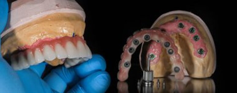 depositphotos_781509176-stock-photo-full-arch-dental-prosthesis-implant.jpeg depositphotos_781509176-stock-photo-full-arch-dental-prosthesis-implant.jpeg