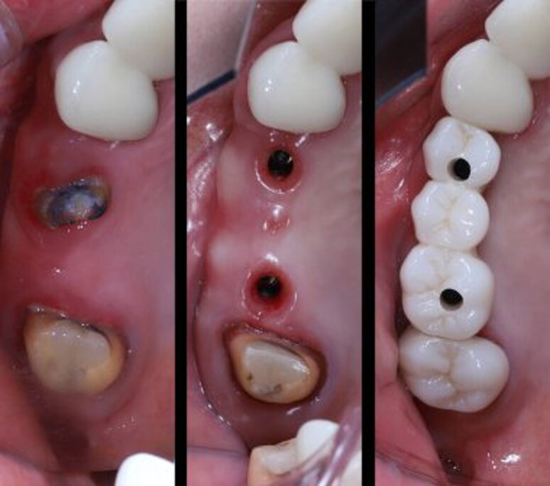 depositphotos_782546838-stock-photo-bridge-prosthesis-treatment-dental-implant.jpeg depositphotos_782546838-stock-photo-bridge-prosthesis-treatment-dental-implant.jpeg