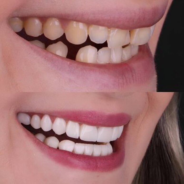 depositphotos_781507692-stock-photo-aesthetic-smile-design-treatment-dental.jpeg depositphotos_781507692-stock-photo-aesthetic-smile-design-treatment-dental.jpeg